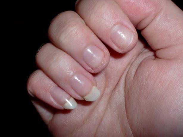 Trnak ucu deformasyon balangc, keratin hormonu yetersizlii.