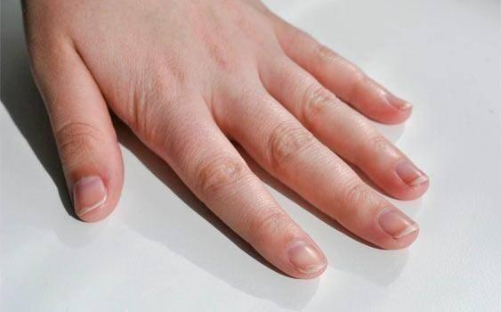 Trnaklardaki lekeleri herkes vitamin eksiklii veya demir ve potasyum azlndan kaynaklandn zannediyor.