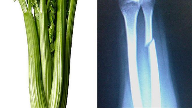 Bu sebze, kemiklerin glenmesi iin temel olan silis maddesini yksek miktarda ierir. Ayrca kemiklerimiz iin gerekli bir dier element olan kalsiyum ynnden de ok zengindir. Hatta arpc benzerliklerini daha da ileri gtrp u bilgiyi verebiliriz: Hem kerevizin hem de kemiklerin %23&#8217; sodyumdan olumaktadr.