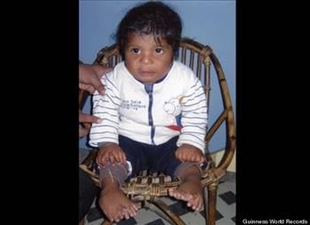 <p><b>Tam 34 parma var </b></p>    El ve ayak parmaklarnda toplam 34 parma olan 1 yandaki ocuk, Guiness Rekorlar Kitab'na girdi.