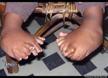 Hintli Akshat Saxena'nn ellerinde yedier, ayaklarnda ise onar parmak var. Saxena, tarihte imdiye kadar en ok parmaa sahip insan olarak Guinness Rekorlar Kitab'na geti. Hindistan'n kuzeyindeki Uttar Paradesh kentinde yaayan Saxena isimli erkek ocuunun annesi Amrita, "lk ocuumuza sahip olunca ok sevindik. Ama daha sonra parmaklarn fark ettik ve oke olduk" aklamasnda bulunuyor.