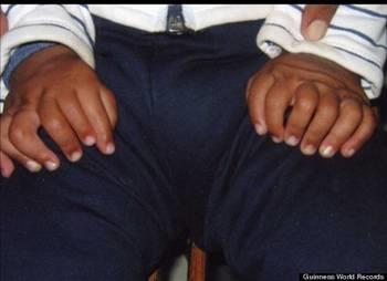 Uzmanlar, bunun genetik bir bozukluk olduunu sylerken aile ocuklarnn zel biri olduunu dnyor. Kk ocukta "polidaktili" denen bir hastalk saptand. Polidaktili el veya ayak parmaklarnda normalde olmas gerekenden daha fazla sayda doutan parmak bulunmas durumu olarak biliniyor.