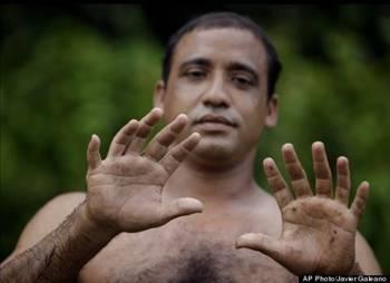 <p><b>12 el, 12 ayak parma var</b></p>    Kba'da yaayan Hernandez Garrido isimli bir adam, normal insanlardan farkl olarak 12 ellerinde, 12 de ayaklarnda olmak zere tam 24 parmaa sahip. lk bakta anlalmayan normal grnl parmaklar, grenleri hayrete dryor. Grdklerine inanamayan insanlar parmaklar tek tek sayyor. 37 yandaki Garrido fazla saydaki parmaklaryla gurur duyduunu belirtirken, bu durumun Allah'n kendisine bir ltfu olduunu sylyor. Aalara trmanp hindistan cevizi toplamann bu ekilde daha kolay olduunu syleyen Garrido, ayrca yaad blgeye gelen turistlerle 10 dolar karlnda fotoraf ektiriyor. Bu rakamn, Kba gibi asgari cretin aylk 20 dolar olduu bir yerde olduka iyi olduunu dnyor. Sabit bir meslei olmad iin parmaklar sayesinde para kazanabildiini ifade ediyor. Yaad bir hatray anlatmay ihmal etmeyen Garrido, ilkokulda iken retmeni 5+5 ka eder sorusuna cevap veremeyince, retmeni parmaklarnla say deyince 12 cevabn vermi. Durumu fark eden retmeni ise, sorduu sorudan dolay ok utanm.