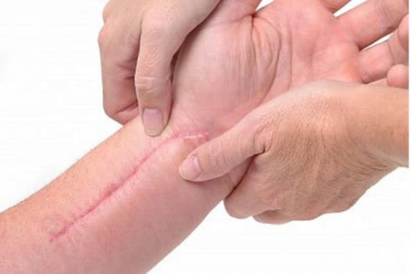 ABD'deki Columbia niversitesi'nin aratrmasna gre iyileme sreci doku zarar grdkten saniyeler sonra balyor.