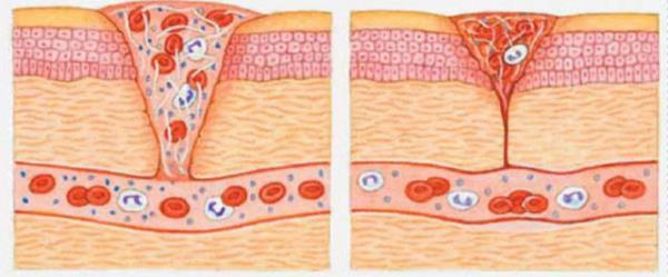 Yarann st kapannca yeni doku oluuyor.