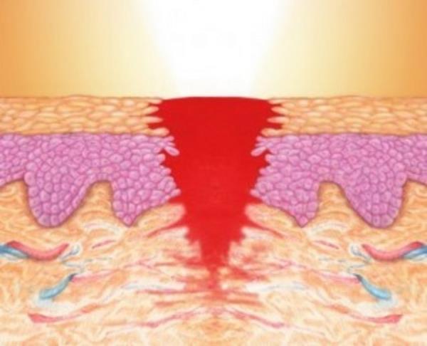 Sonraki iki yla yakn srede o yara dokusu gleniyor ve sonunda normal cilt dokusunun yzde 80'i kadar salam hale geliyor.