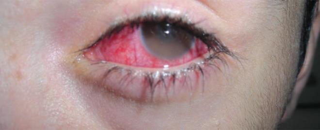 Kuru ksrk ve boazda gck hissi