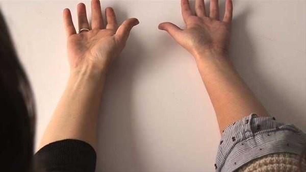 Eer bu hareketi yaptnzda bileklerinizden herhangi birinde (veya ikisinde birden) palmaris longus grnr olmuyorsa, evrimsel olarak her 10 insann 9'undan daha ileri durumda olduunuzu syleyebiliriz