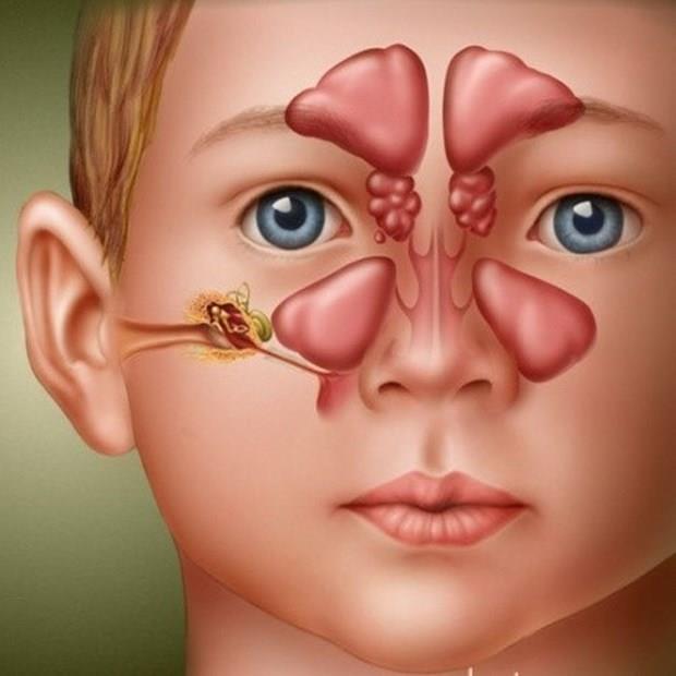 Sinzit: Buruna ve sinslere solunum havasyla ulaabilen mikroplar burada enfeksiyon oluturuyor. Genellikle st solunum yolu enfeksiyonunu izliyor. Burun tkankl, koyu sar-yeil renkte burun aknts, ate, di ve ba ars, burundan konuma gibi belirtileri var. Sinzit tedavisinde tbbi tedaviye ek olarak gnde 1-2 kez 1 litre suya 1 orba ka kadar kuru papatya konularak buharn solumak sinsleri rahatlatr. Bunu 3-4 gn sresince yapmak fayda salar.