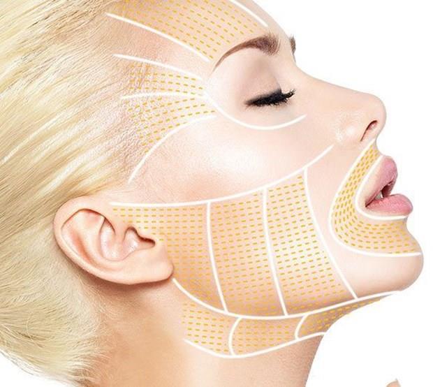 rmcek a ve iple asma: ok sayda ince ipin a gibi cilt altna yerletirilmesi olarak bilinen ''rmcek a'' yntemi ile cildin gerilmesi ve krklklarn giderilmesi salanabiliyor. pler vcutta yaklak 240-300 gn iinde eriyor, olumlu etkileri 2 yla kadar sryor. Yz ve boyun iin yaklak 20 dakikalk srede krklklar amak, sarkmalar dzeltmek mmkn olabiliyor.