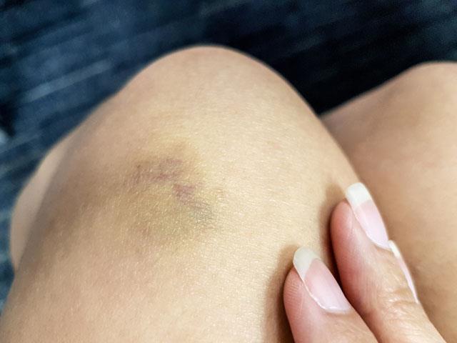 En ufak bir darbede ve sk sk morarmalar