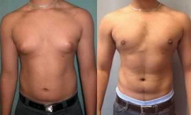 Erkeklerde gs bymesi