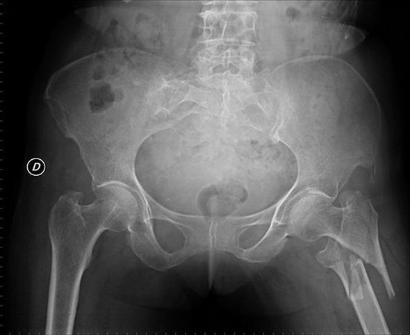 nsanlarn kala kemikleri betondan ok daha salamdr.