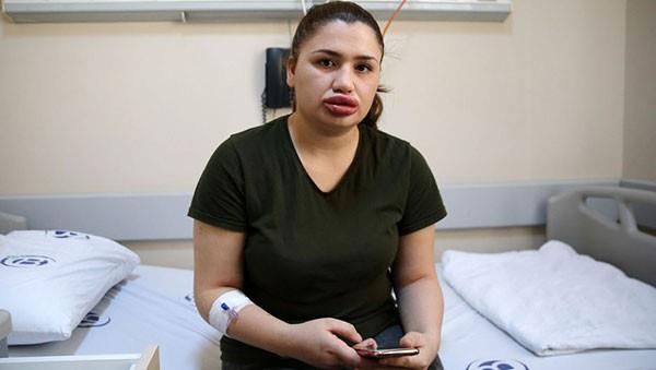Adana'da kendisini doktor olarak tantan kadn kuafrne dudak silikonu yaptrdktan sonra dudaklarn kaybetme tehlikesi yaayan hemire Merve Kele, sosyal medyadan son halini paylat.