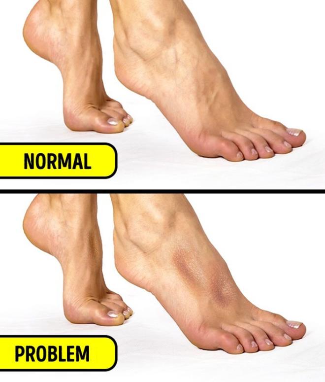 5- V&uuml;cudunuzdaki sv oran<br /> &nbsp;  Ayanzn st veya alt ksmn ba parmanzla bastrn. Ba parmanz kaldrdktan birka saniye sonra ayakta bir girinti varsa, vcudunuzun sv tutma konusunda bir sorunu olmas ihtimal dahilinde. Diyetinizdeki tuz miktarn azaltmanz ve ilenmi gdalar tketmeyi kesmeniz gerekiyor.