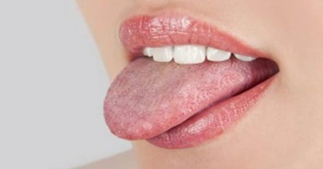 Fark edilmesi zor olduu iin dilin altnda kalan bu blgenin dikkatle muayene edilmesi gerekir. Hastaln kesin tans, lezyondan alnan biyopsinin patolojik deerlendirilmesi ile konur&#8221; eklinde konutu.