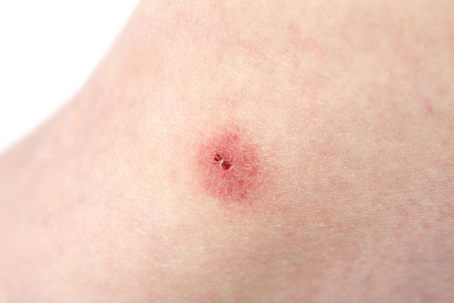 Tm hastalklarn rahatszlklarnda deride belirti olabilir. Karacierin bu anlamda zel bir yeri yok. Isrklar tedavi edilmezse mikrobik hale gelebilir. Vcuda yaylp ciddi enfeksiyonlara yol aabilir.&#8221;