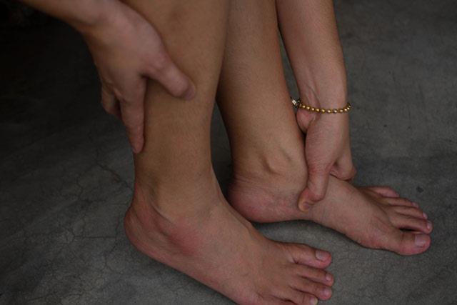 lalar:<p>    ime, baz ilalarn alnmasnn ardndan da ortaya kabilir. rnein, antipiretik, analjezik veya doum kontrol haplar gibi&#8230;    <p>Ne yapabilirsiniz: la imeye neden oluyorsa, bir doktora dann. Byle yan etkilere neden olmayan baka bir ilala deitirilebilir.