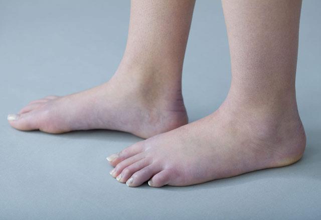 Karacier sorunlar:  <p>  Karacier sorunlarn, bacaklarnzdaki duruma gre nceden belirleyebilirsiniz. Karacierin anormal ekilde almas durumunda bacaklarda hem ilik hem de rmcek ana benzeyen damarlar grlr.