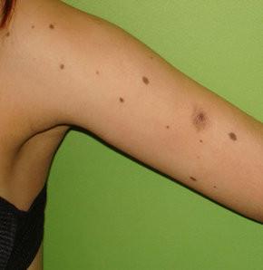 "Benin rengi homojense yani sadece tek renk hakimiyeti varsa sorun olmayabilir ama kahverengi, siyah, krmz gibi birden fazla renk olumaya balamsa bykl de 6 milimetrenin zerindeyse tmr geliimi asndan riskli benler olarak dnlmelidir"