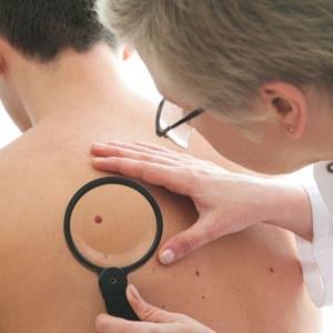 "Hekim olmayan insanlar bile benlerini kontrol ederek, bunu deerlendirebilme ansna sahiptir. rnein ben asimetrik bir grnt arz ediyorsa ktye iaret demektir. Yine benin kenarlar kvrntl veya dzensiz grnmdeyse olumsuz bir durum sz konusudur"