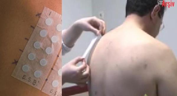 Cumhuriyet niversitesi (C) Tp Fakltesi Dermatoloji Anabilim Dal retim yesi Prof. Dr. Melih Akyol, ok fazla beni bulunan kiilerin deri tmrne yakalanma riskinin yksek olduunu syledi.