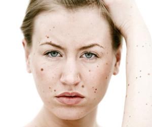 Prof. Dr. Melih Akyol, vcutta giysilerin kapatmad blgelerdeki benlerin gne ndan korunmas gerektiini, uzun sre gne na maruz kalan ve benlerde olumsuz ynde deiim gsterme riskinin artacan syledi.