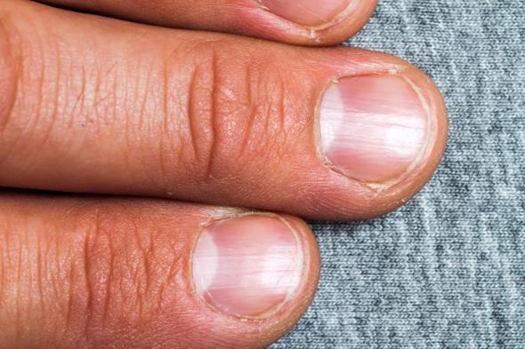 Trnaklarnzn yzeyinde trtklar varsa...<p>  Mide asitleriniz yetersizde, yediklerinizi olmas gerektii gibi paralayp ihtiyacnz olan vitamin ve mineralleri alamyor olabilirsiniz. Bunun nedeni ounlukla bilinsiz antiasit kullanmdr. zm olarak bir bardan suya biraz elma sirkesi ekleyip yemek srasnda iebilirsiniz. Bylece yemek sonras ikinliiniz de geecektir.