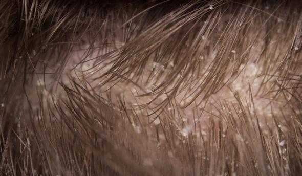 Sa deriniz pul pul dklyorsa...  <p>  Sa derisi dklen kiilerin ilk aklna gelen genelde kepek olur. Ancak bu durum aslnda vcudunuzun omega 3, alfalinolenik asit gibi salkl ya asitlerinden mahrum kald anlamna da gelebilir. Bunu nlemek amacyla bal, fndk, ceviz gibi kuruyemileri, keten tohumu gibi yal tohumlar beslenmenizden eksik etmeyin.