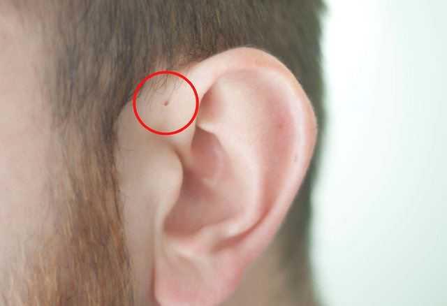 Avrupa'da ve Amerika'da "preaurikler sins" ile doan kiiler, nfusun yzde 1 ila yzde 9'unu oluturuyor.