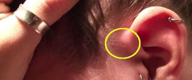 Teknik olarak doumsal bir kusur olan bu minik delik, ilk kez Van Heusinger tarafndan 1864 ylnda belgelere dayandrld.