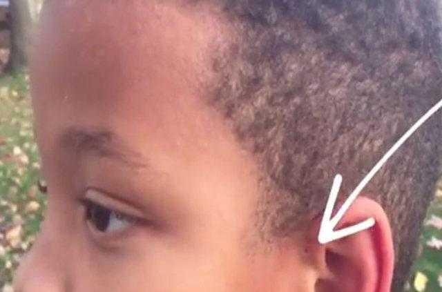 Evrimsel biyolog Neil Shubin'e gre; bu delikler, balk yzgelerinin bizdeki evrimsel kalnts olabilir. Genellikle "preaurikler sins"e sahip olmak nemsenecek bir ey deil.