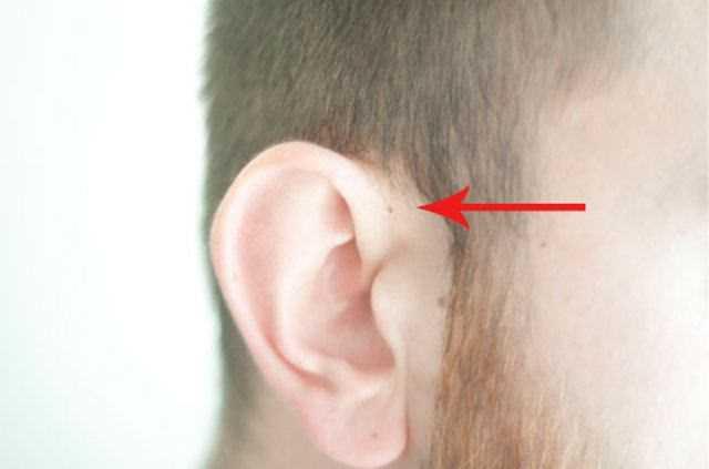 "Preaurikler sins" sadece bir kulakta meydana gelebilecei gibi iki kulakta da olabilir. Bununla beraber aratrmaclar, genellikle bu deliin sa kulakta grldn sylyor.