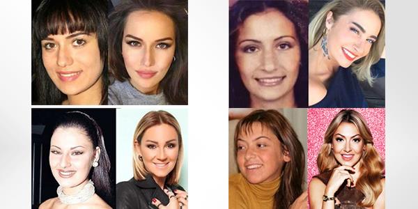 Artk kadnlar kuafre gider gibi dolgu-botox yaptrmaya gidiyor. Bu da operasyonlarn normallemesini salyor. Ancak yle rnekler var ki, kiiler kendilerini bu operasyonlara adayp tamamen baka insanlara dnyor. te buna rnek olarak gsterebileceimiz nller.