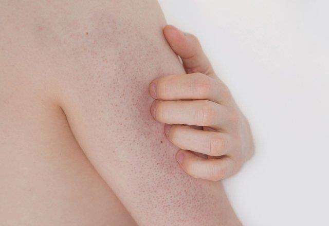 KK KABARCIKLAR  Sklkla kollarn d yznde ve gz kenarlarnda oluan minik kabarcklar bata kolayca sivilce zannedilebilir. Ancak bunlar aslnda keratosis pilaris olarak bilinen bir deri rahatszldr. Yeterince gerekli ya asitleri, inko ya da A vitamini alnmadnda ortaya kar.