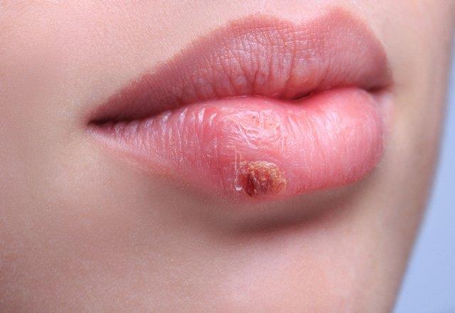 DUDAK EVRESNDE OLUAN YARALAR   Dudak evresinde oluan yaralarnz uzun bir sredir gemiyorsa, B2 ve B12 ynnden demir ve vitamin eksikliiniz olabilir. Koyu yeil yaprakl sebzeler, fasulye, tavuk ve sr eti gibi demir ve B vitamini bakmndan zengin gdalar sayesinde bu durumu kontrol altna alabilirsiniz. Ayrca, bu besinleri lif bakmndan zengin gdalarla tketmek, demir ve B vitamini emilimini arttrmak iin nemli.