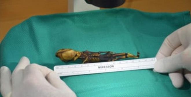 Bhattacharya, kkrdak dokular iin kullanlan kolajeni retme sorunu yaratan ve skolyoz olarak bilinen omurgann eriliine neden olan genlerin de mumya iinde bulunduunu ifade etti.    Bilim kadn, iskelet malformasyonlarnn tesinde Ata&#8217;nn, konjenital diyafram hernisi olarak bilinen bir hastala sahip olabileceini de szlerine ekledi.