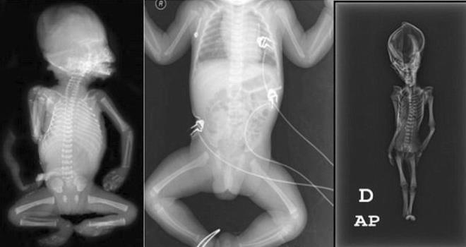 California niversitesi, San Francisco niversitesi ve Stanford niversitesi tarafndan &#8220;Ata&#8221; ismi verilen mumyaya yaplan DNA analizleri, ,gizemini uzun sre koruyan kalntnn, eitli genetik mutasyonlara uram, 6-8 yanda olduu tahmin tahmin edilen cce bir kz ocuuna ait olduunu ortaya koydu. Yaplan bilimsel almalar, ocuun 40 yl nce ldn ve bugne kadar tanmlanmam olan gen bozukluklarna sahip olduunu aa kard.