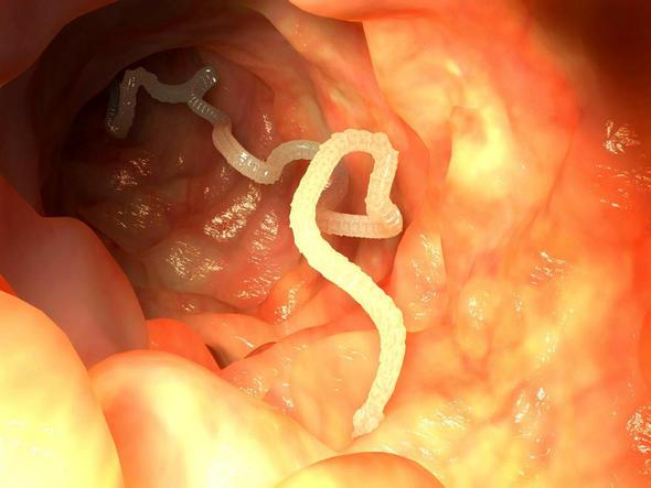 Sizce ylda ka insan barsak kurdu yznden lyor?