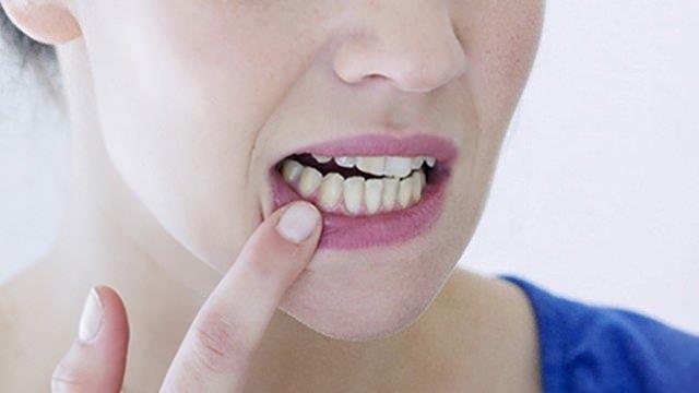 Dilde oluan yaralar tedavi eder.