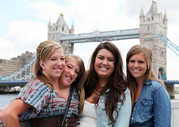 Yapk ikizler Abby ve Brittany, 27 yldr ayn bedende yayorlar. kizlerin ortak bedeni olmasna ramen kendilerine ait balar var. Son derece nadir grlen bu tr vakalarda, cerrahlar ikizleri ayrmay sakncal gryor.