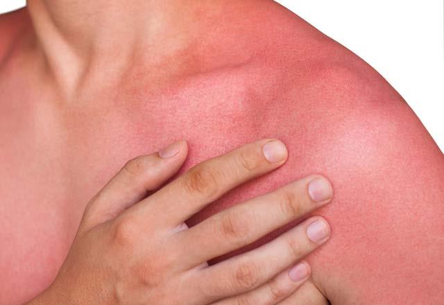 Gne yanklarn geirir<br>    Turu suyunun tuzlu olmas sizi kesinlikle yanltmasn. Turu suyundaki mineraller gne yanklarna iyi gelerek yanma hissinizi ksa srede azaltacaktr.    Yank olan blgeye bir miktar turu suyu srn ve sonucu kendi gzlerinizle grn.