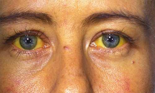 SARILIK  <br>  Sarmsak da bunu iyiletirmek ve toksin karmak iin harika. Sarmsak iyi enzimleri aktive eder ve karacieri iyi alr. Karacierimizin vcuda detoks yapmas iin slfr ihtiyac vardr ve sarmsak bum ierir. Bu karacier iin ok nemlidir ve yal karacier hastal iin daha da iyi. Allicin, selenyum da ierir ve daha fazla safra oluturarak karacierin yalar azaltlr. Allicin zararl saldrlara kar sarmsan savunma mekanizmasdr diyebiliriz. Bu karm 5 gn boyunca ierseniz, sarlk kaybolur.