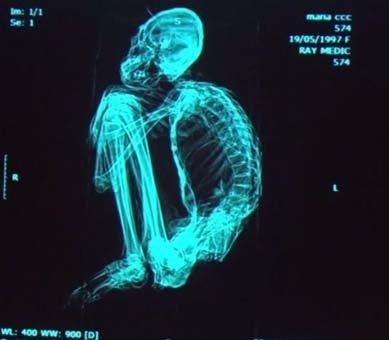 Mumya zerinde bilinen hibir hastala ait iz bulunamad.