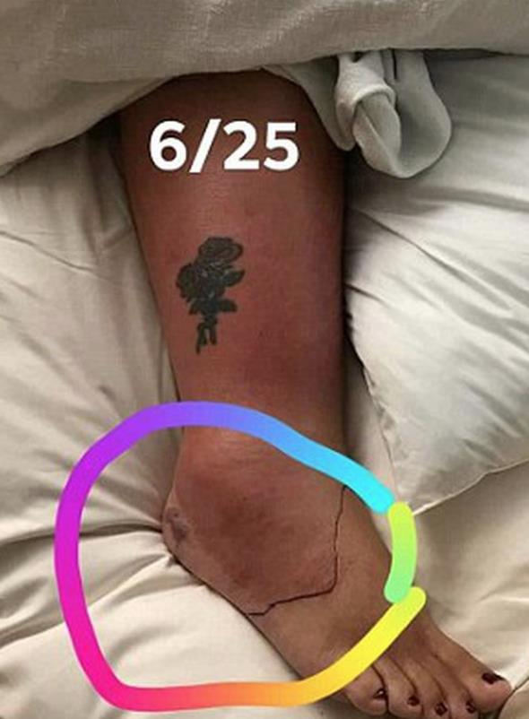 BACAI MEYE BALADI; Vcudunda titremeler de balayan talihsiz kadnn baca aniden imeye balad. Acilen ambulans aran kadna doktorlar mdahale etti. Bacandaki ien yerler alnan kadna 3 ay tedavi uyguland.