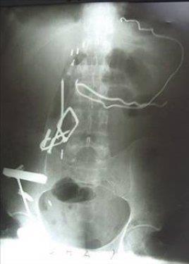 ran'da, korkusunu bastrmak ve skntlarndan kurtulmak iin madeni nesneleri yiyen gen kzn karnndan ameliyatla yarm kilogram arlnda metal paralar karld.