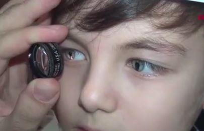 GZLERNDE HERHANG BR SORUN YOK<br>    Gz Hastalklar Uzman Operatr Doktor Ali Aghayarov, "Kayra Emir Polat'n gzlerinde herhangi bir grme kayb sz konusu deil, belki ilerleyen yalarda kk bir operasyonla bu rahatszlk dzeltilebilir. Kolobom gz ameliyat, genetik zellikler, gz travmas gibi nedenlerden dolay ortaya kabilir. Ancak yine de ou kolobom vakasnn bilinen bir nedeni yoktur. Bu hastalk sk grlen bir ey deil. Ama Trkiye'de ve dnyada rnekleri var" dedi.