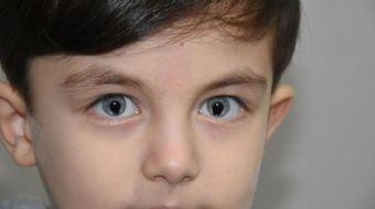 Baba Yakup Polat ise "Kayra doduunda biz de anlayamadk. ki ay getikten sonra gzlerindeki farkl olduunu grdk. Doktora gtrdk, 'dier gzlere gre ok farkl' dediler. nsanlarn dikkatini ekmeye balad. Kedi gz gibi diyenler ok oldu. Doktorlar 6 ayda bir kontrole getirmemizi sylediler. Daha ileride kk bir ameliyat gerebilir dediler. Kayra karanlkta grdn sylyor, nasl grdn bilmiyorum" diye konutu.