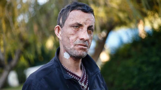 Nakil ncesi zorlu bir hayat olduunu, evinden kamadn dile getiren Acar, "ocuklar benden korkuyordu, hi arkadam yoktu. Yeni yzmden sonra arkadalarm oldu, iim, gzel bir ortamm oldu. Nakille btn skntlarm son buldu." dedi.    Hala kendisini ryada gibi hissettiini ifade eden Acar, Trkiye'nin ilk yz nakli olan hastas olmaktan ve insanlarn youn ilgisinden mutluluk duyduunu belirtti.