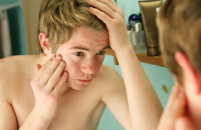 Ayrca terlemek, sivilcelerin artmasna neden olur. Akne lezyonlarn kapatmak iin youn ve uygunsuz kozmetik rnleri kullanmak derideki gzenekleri tkayarak, hastaln artmasna neden olabilir. Cildi ok fazla kurutansa bunlardan, temizleyicilerden uzak durmanz gerekir. Temizleyicilerin, cildin doal ph&#8217;na yakn olmasna dikkat edilmelidir...